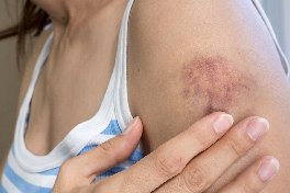 scar revision surgery in bangalore